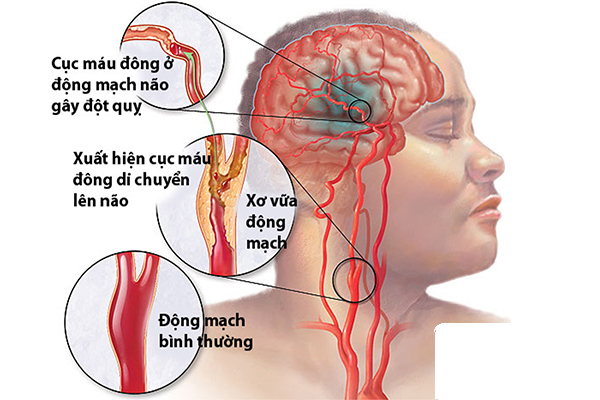 Phương pháp mới điều trị tai biến mạch máu não