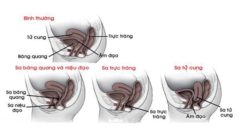 Bệnh viện đa khoa Thiện Hạnh triển khai phẫu thuật nội soi điều trị sa sinh dục