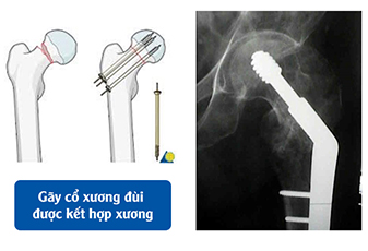 Bệnh viện Thiện Hạnh: Gãy cổ xương đùi