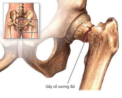 Bệnh viện Thiện Hạnh: Gãy cổ xương đùi ở người già và phương pháp thay khớp háng				nhân tạo