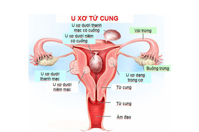 Thêm một trường hợp phẫu thuật cắt khối u xơ tử cung dưới thanh mạc nặng 3200gr
				tại Bệnh viện Thiện Hạnh