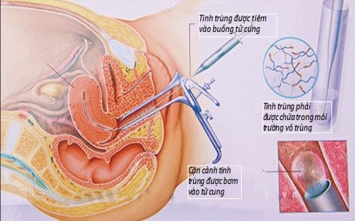 Tìm hiểu về phương pháp thụ tinh nhân tạo (IUI) tại Bệnh viện Thiện Hạnh