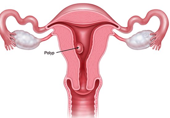 Phẫu thuật nội soi cắt khối polyp buồng tử cung