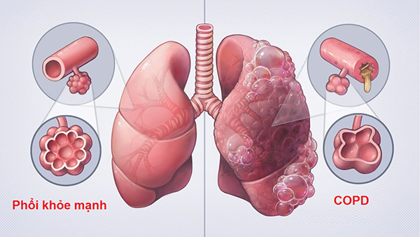 Bệnh phổi tắc nghẽn mạn tính nếu nhiễm nCoV sẽ rất nguy hiểm