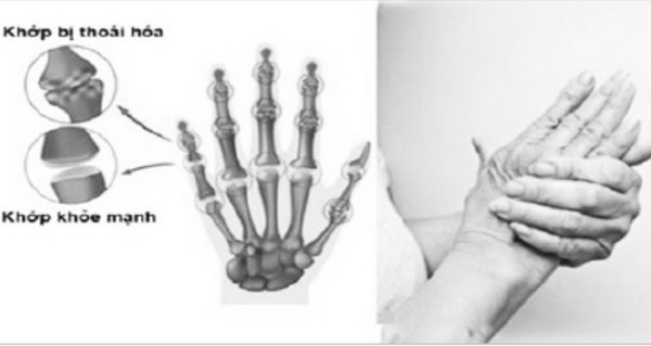 Đề phòng viêm thoái hoá khớp ngón tay