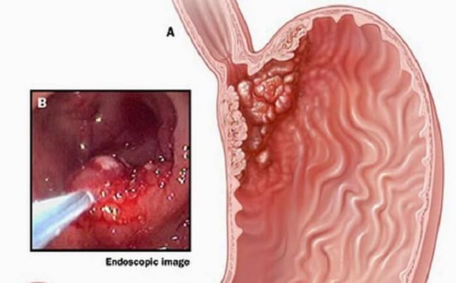 Dấu hiệu ung thư dạ dày giai đoạn sớm