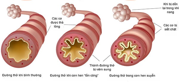 10 yếu tố khiến hen phế quản nặng lên