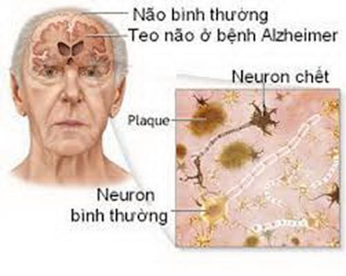 Phòng bệnh Alzheimer ở người lớn tuổi