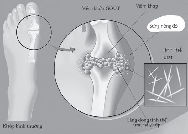 Đối phó với tăng acid uric máu ở người cao tuổi