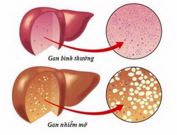 Phòng ngừa bệnh thường gặp ở gan