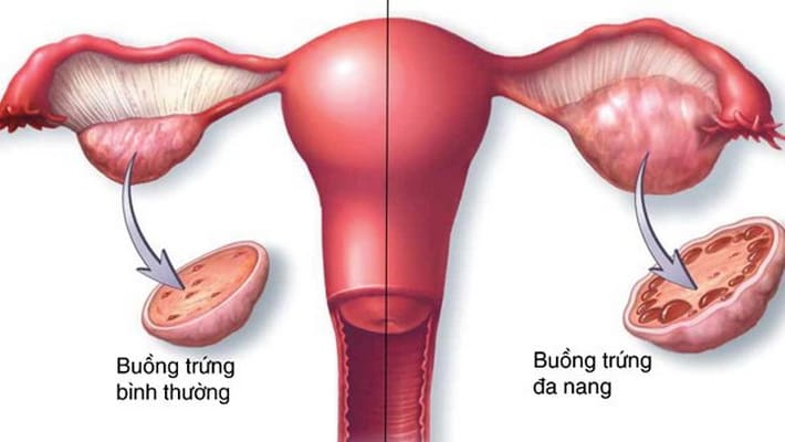 Bệnh lý ở buồng trứng gây khó thụ thai