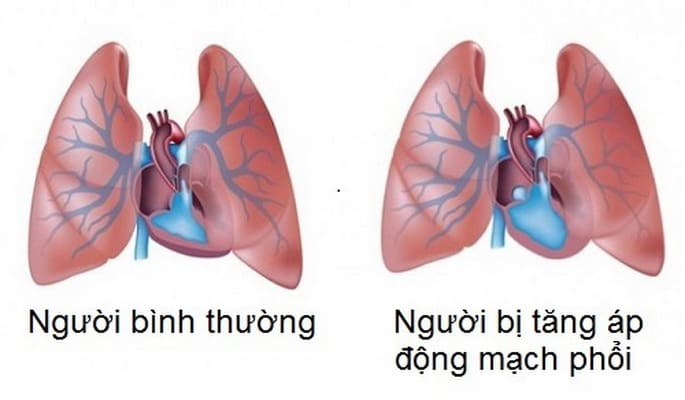 Tăng áp động mạch phổi và những lưu ý_resize