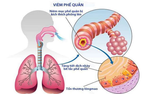 Cảnh giác biến chứng của viêm phế quản cấp