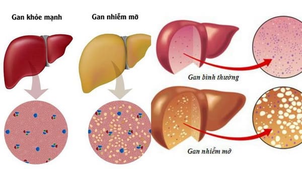 Nhận diện và phòng ngừa gan nhiễm mỡ