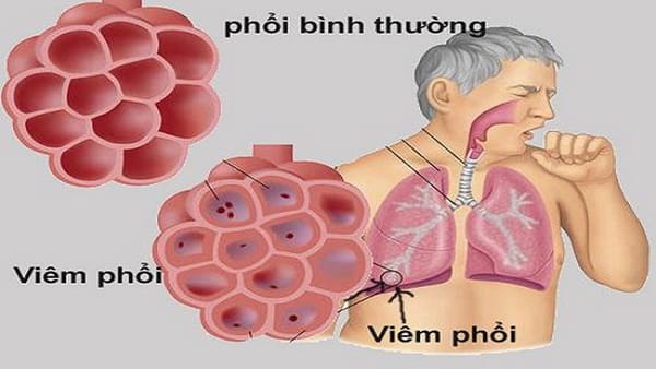 Những bệnh dễ gặp ở phổi và lời khuyên phòng bệnh từ bác sĩ