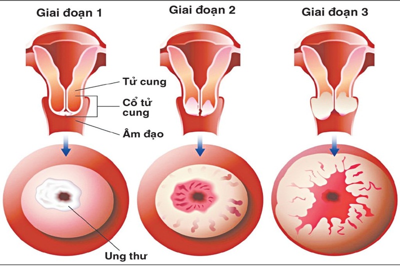 Dấu hiệu cảnh báo ung thư cổ tử cung