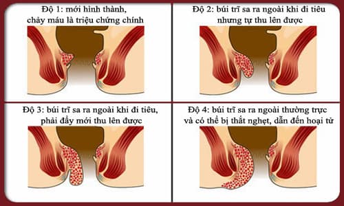 Ngừa bệnh trĩ ở người cao tuổi