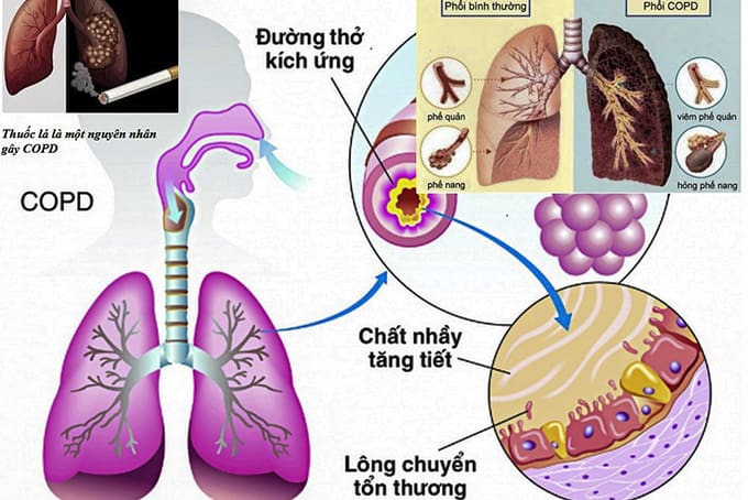 Ngoài thực hiện 5K và tiêm vắc xin – 8 lời khuyên để giữ cho phổi bạn khoẻ hơn