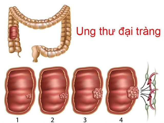 Các yếu tố nguy cơ của ung thư đại trực tràng bạn cần biết