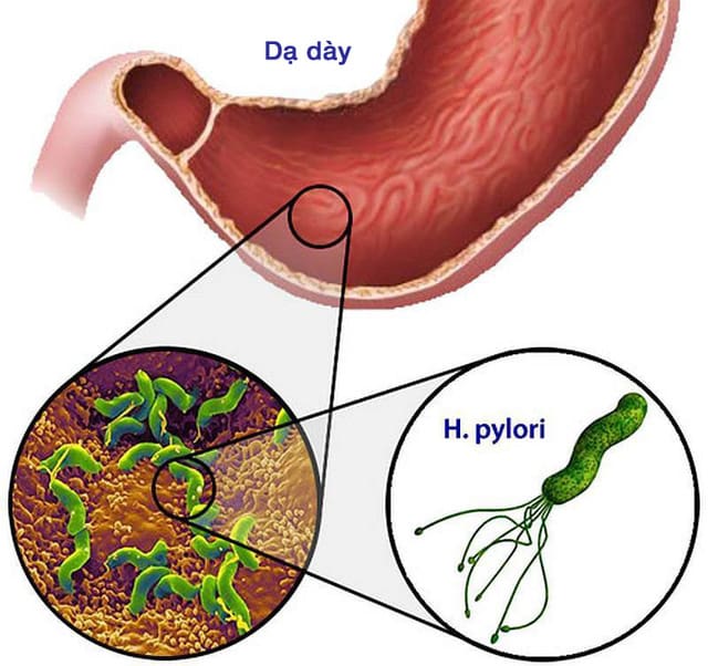 Nhiễm vi khuẩn Helicobacter pylori và nỗi lo ung thư dạ dày