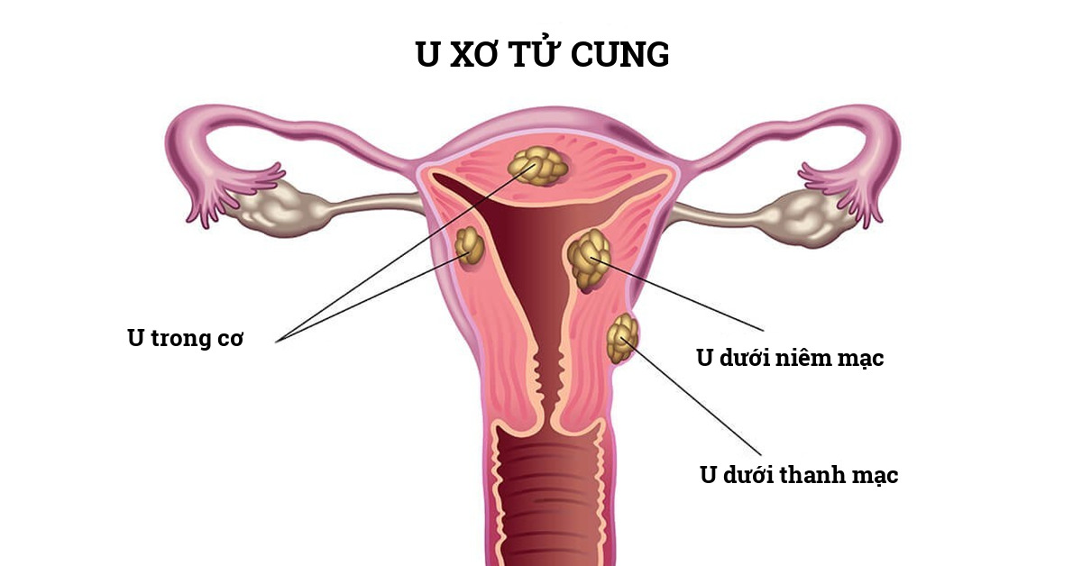 U xơ tử cung: Nguyên nhân, dấu hiệu nhận biết và cách điều trị