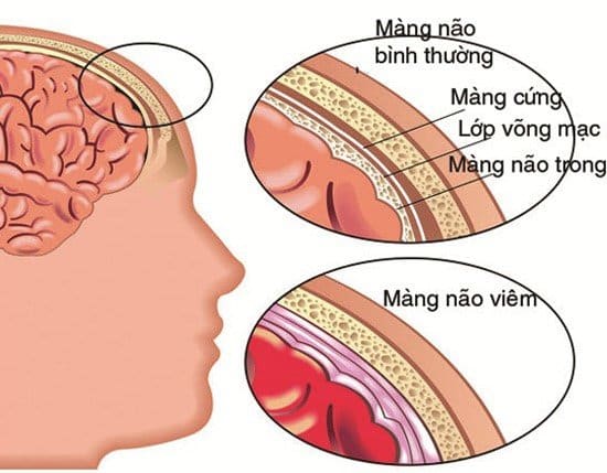 Viêm não cấp ở trẻ em: Dấu hiệu nhận biết, nguyên nhân và những lưu ý