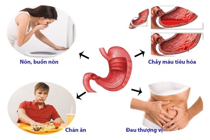 5 nguyên tắc ăn uống dành cho người bị viêm loét dạ dày