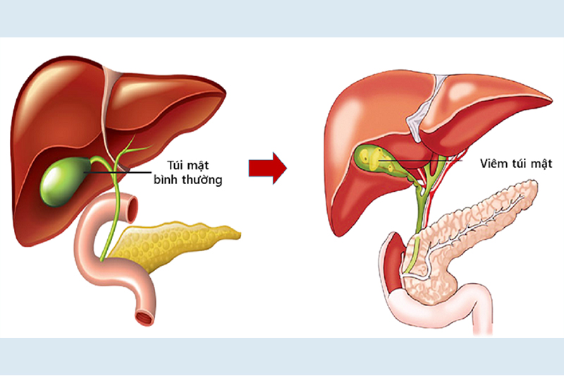 Nội soi cắt túi mật cho bệnh nhân lớn tuổi