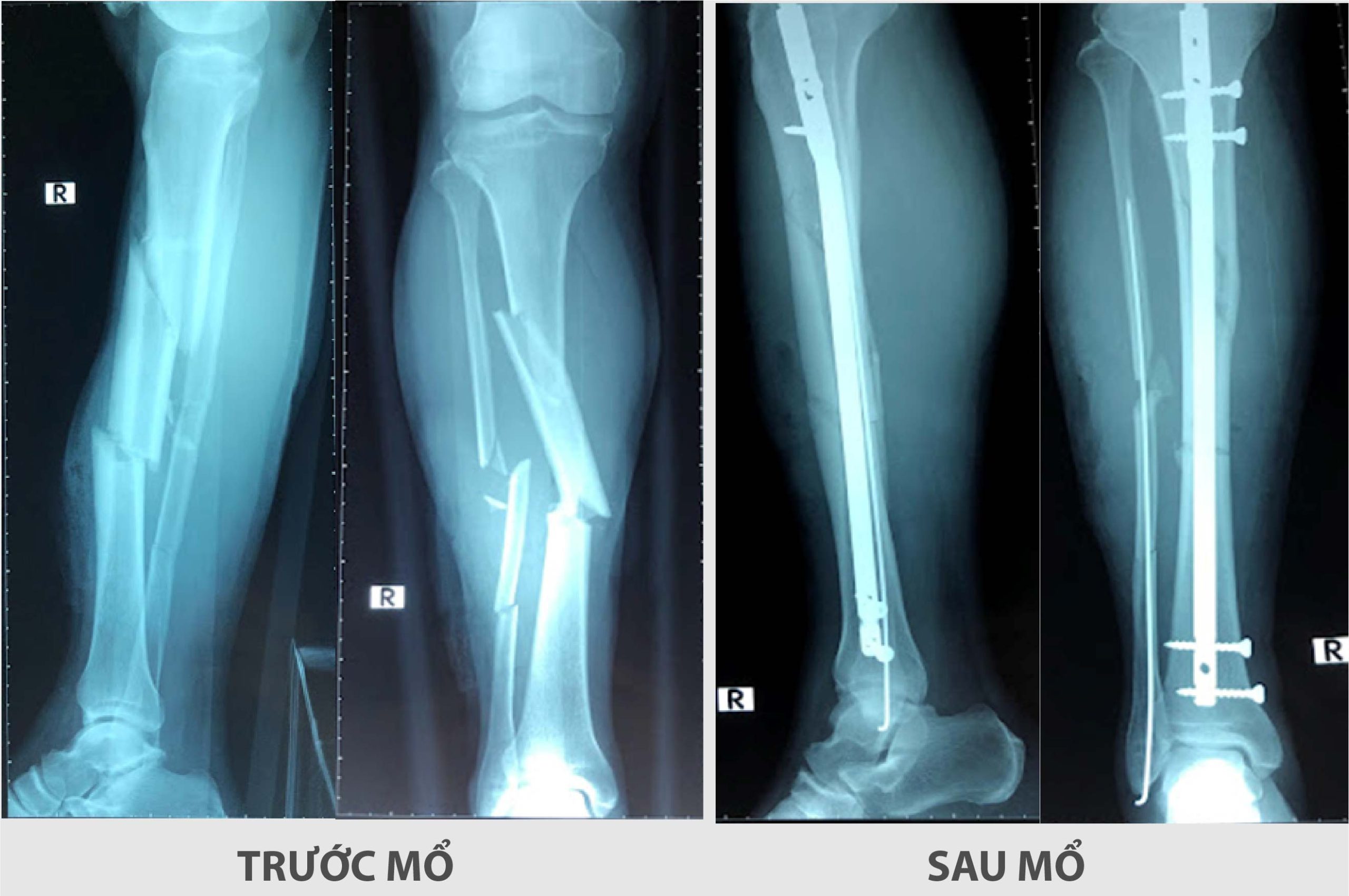 Điều trị thành công cho bệnh nhân lớn tuổi gãy xương nghiêm trọng