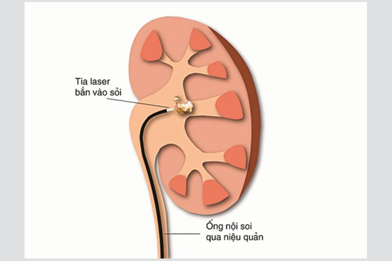 Tán sỏi laser qua ống soi mềm là gì?