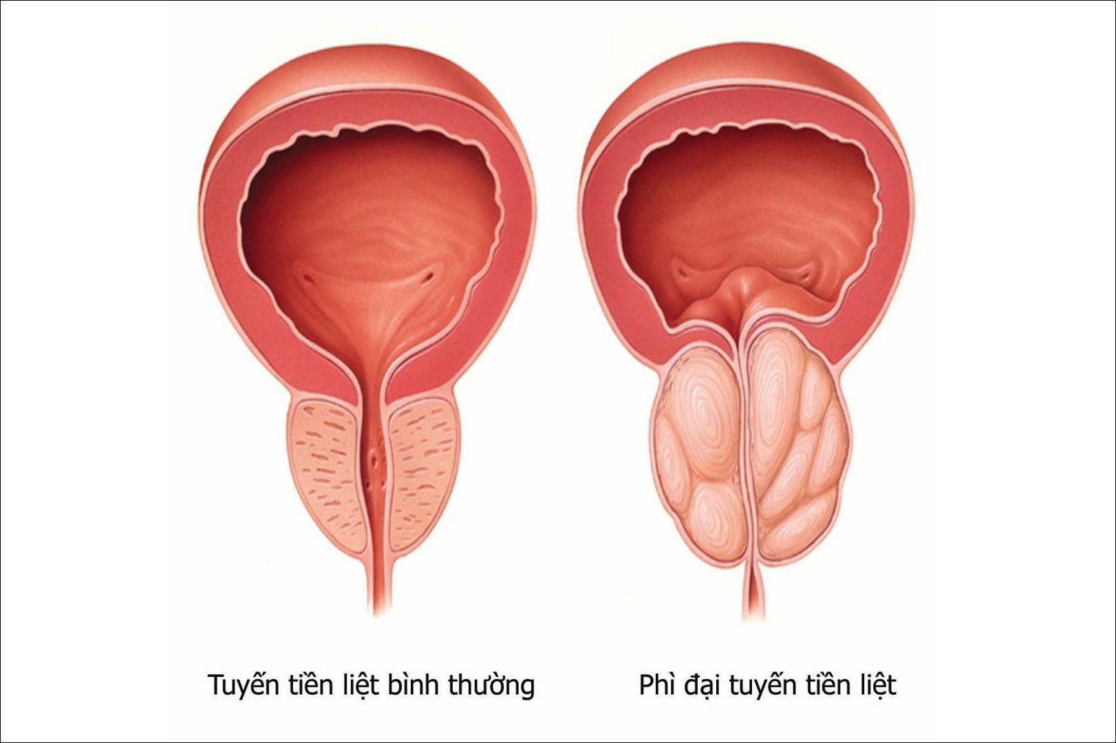 Mổ nội soi cắt đốt bướu tiền liệt tuyến