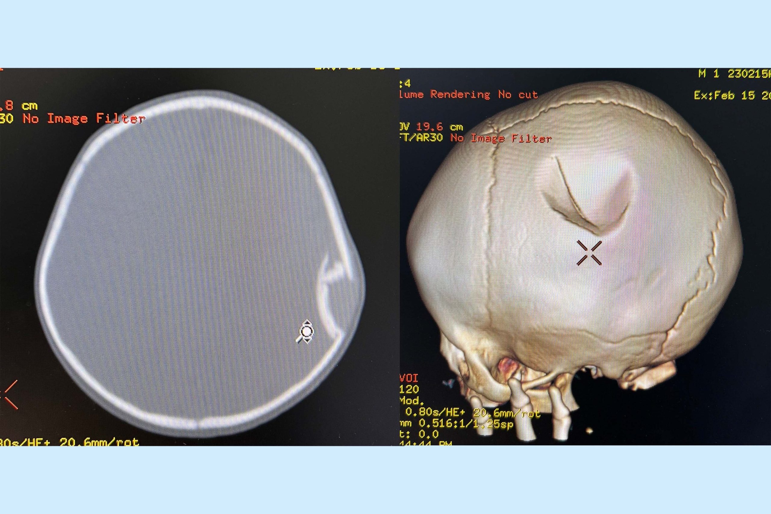 Mổ cấp cứu thành công cho bé trai 10 tháng tuổi bị ngã lún sọ