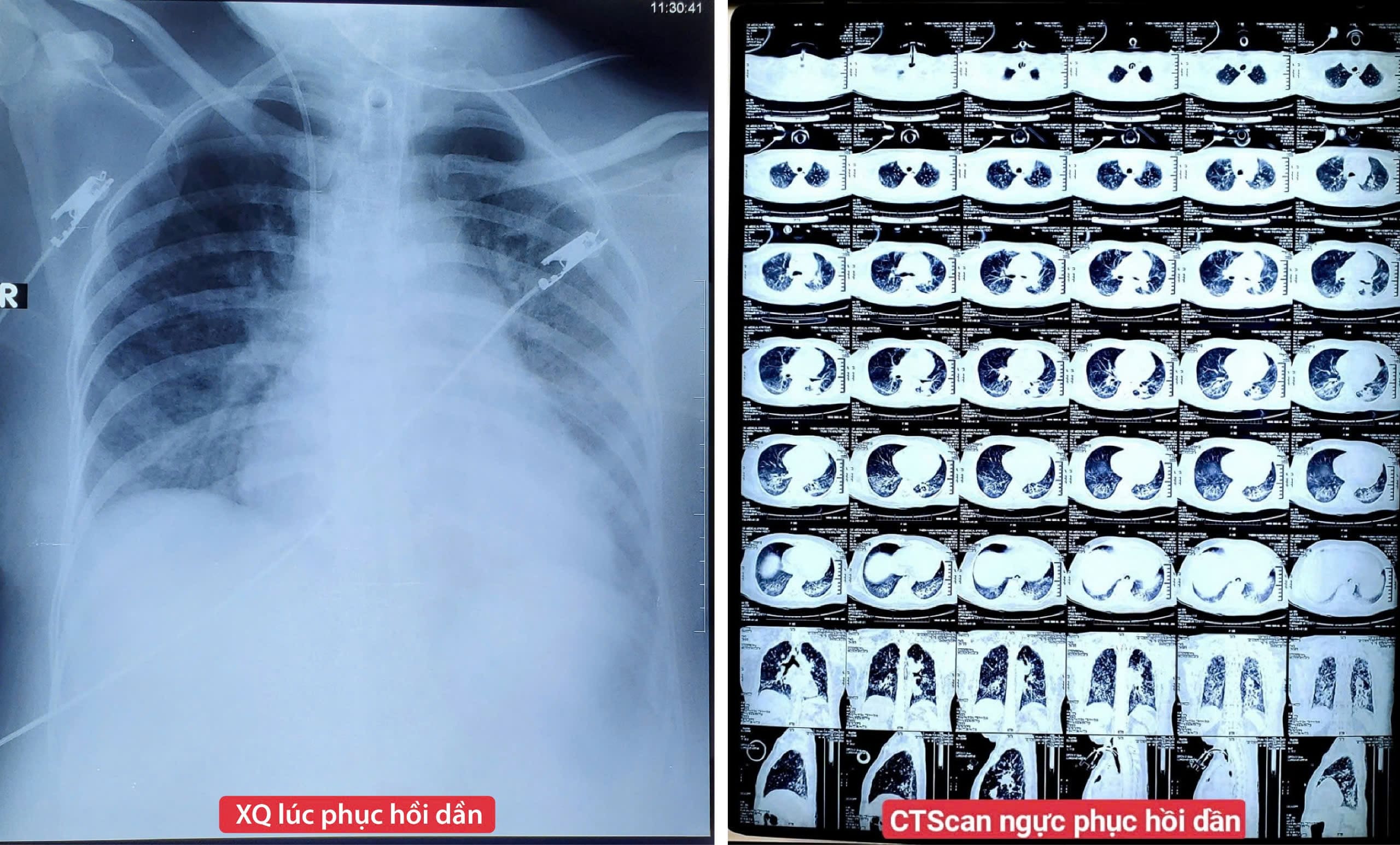 Hình ảnh chụp X-quang và CT Scan ngực lúc bệnh nhân dần phục hồi