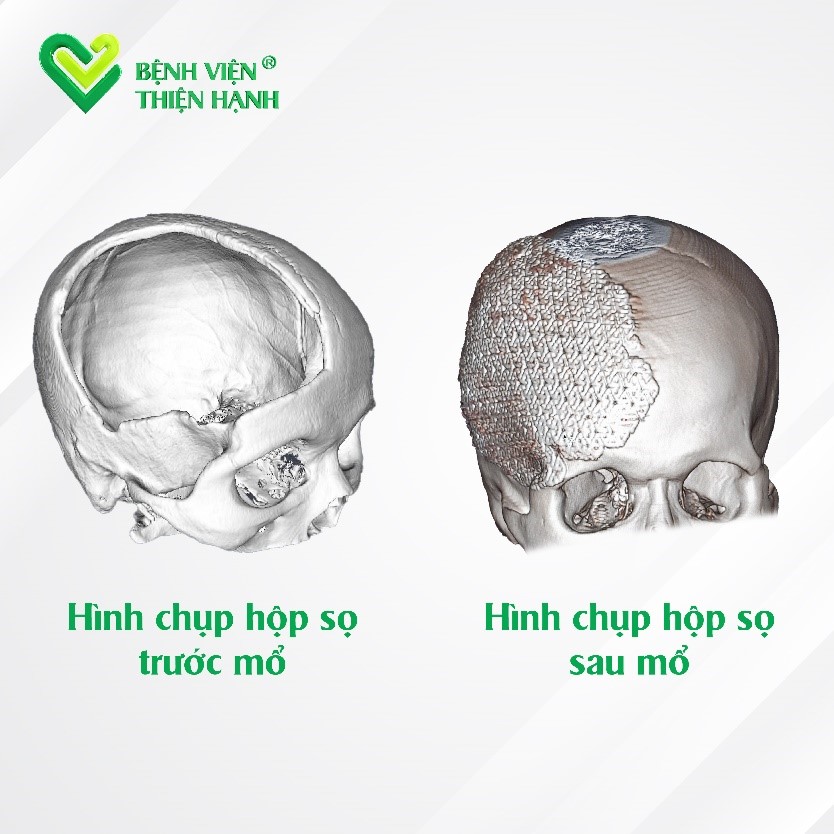 Tại tạo hình hộp sọ với hình dáng, kích thước sọ thật bằng công nghệ in 3D