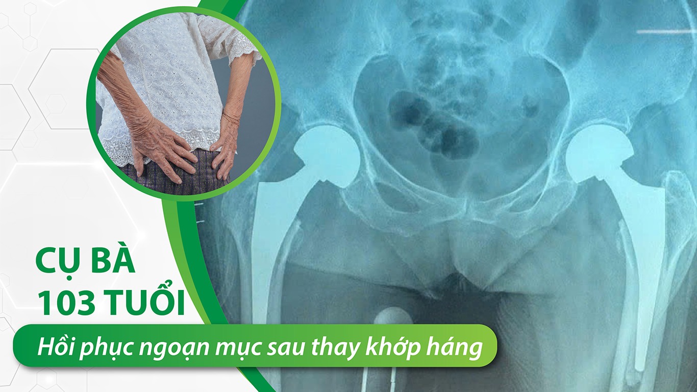 Sau khi té ngã gãy cổ xương đùi, cụ bà 103 tuổi trải qua hai lần phẫu thuật thay khớp háng trái, phải tại Bệnh viện Thiện Hạnh và hồi phục ngoạn mục trong thời gian ngắn.