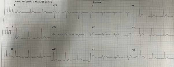 Điện tâm đồ dạng Brugada của người bệnh lúc nhập viện