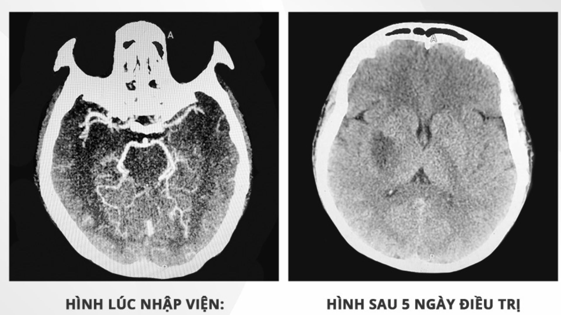 Cấp cứu thành công bệnh nhân 44 tuổi đột quỵ cấp, trở lại sinh hoạt bình thường sau 6 ngày điều trị